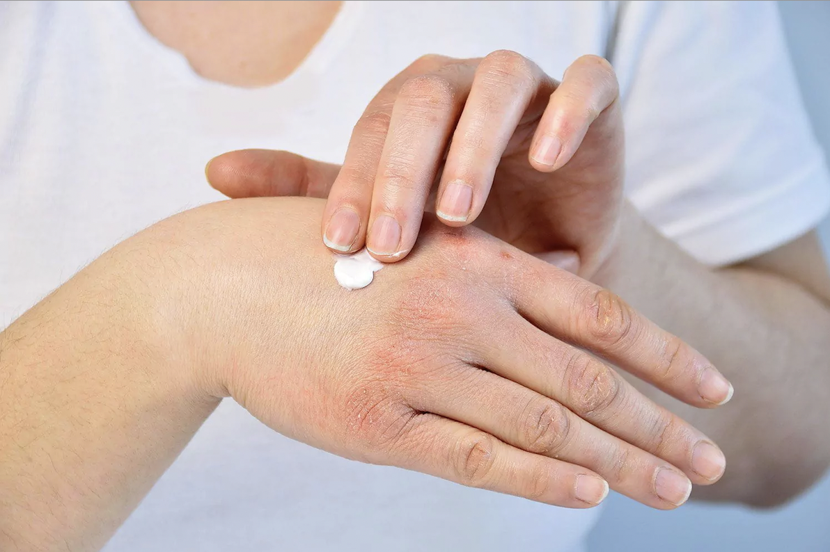 Сухость кожи симптомы. Чувствительная кожа. Сухая кожа. Экзема импетигинозная. Сухость кожи симптомы.