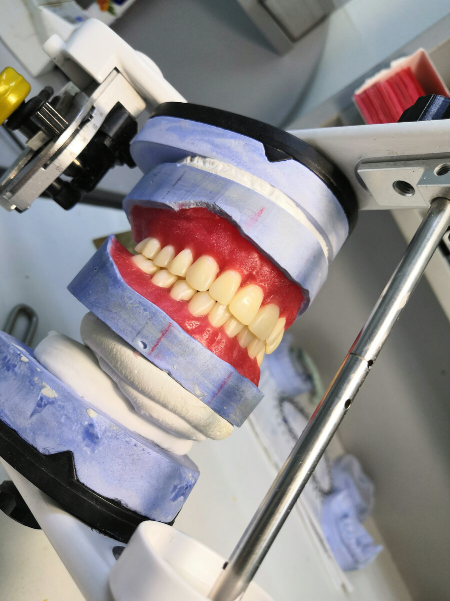 Рисунок 2. Полные съемные протезы моего производства. 