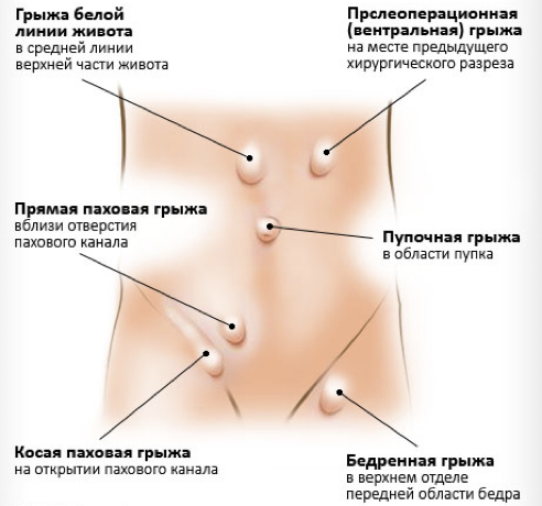 Вентральная или рубцовая грыжа ᐉ диагностика, лечение в МЦ БОГОЛЮБЫ, Луцк