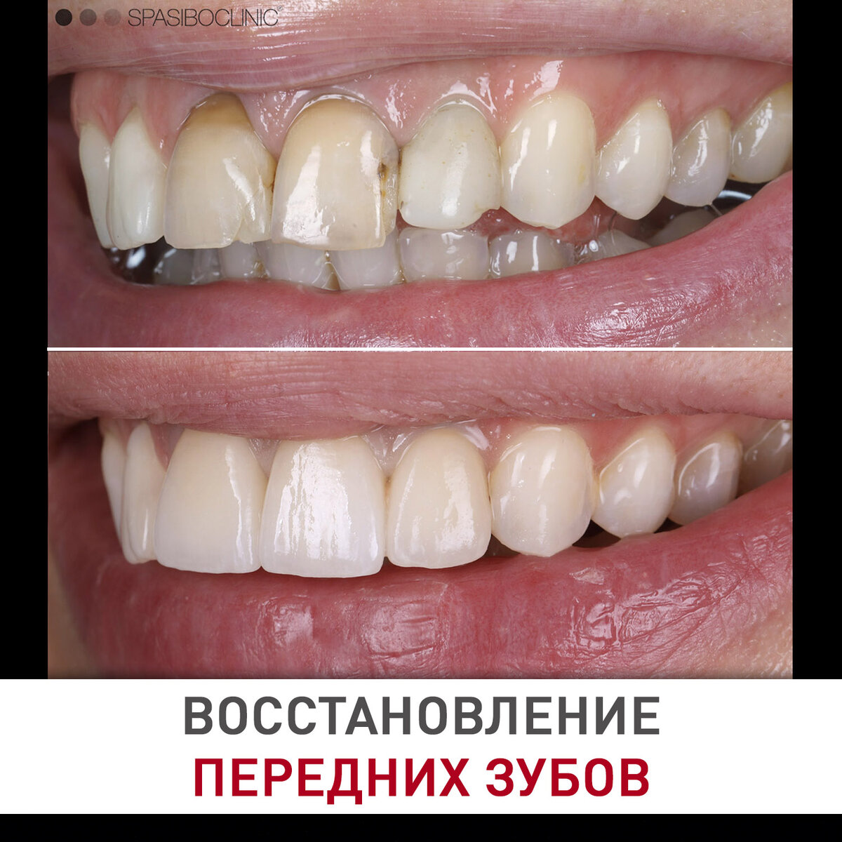ВОССТАНОВЛЕНИЕ ПЕРЕДНИХ ЗУБОВ | Спасибо.Клиник | Дзен