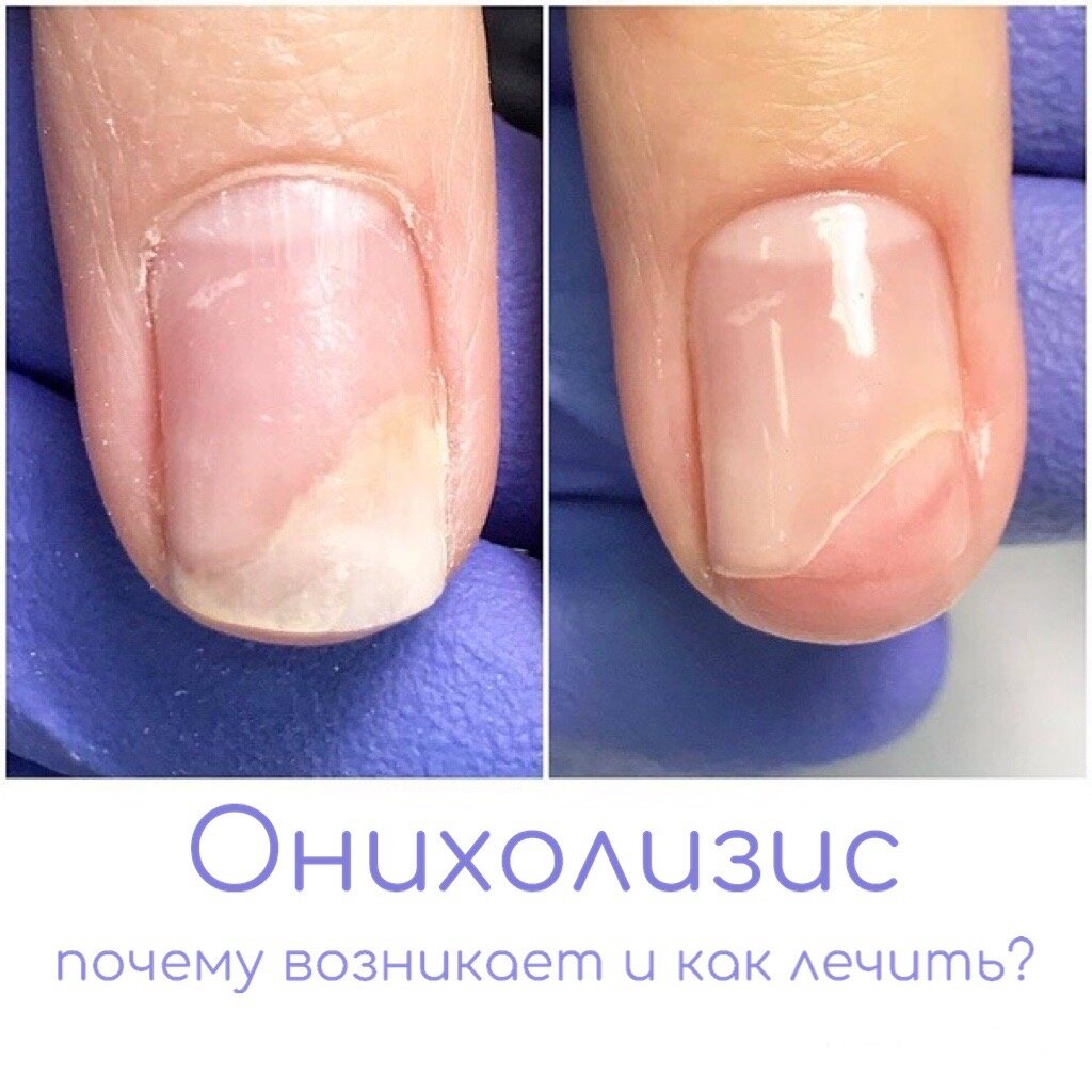 Лечение ногтей в домашних условиях | imkosmetik журнал о маникюре и красоте