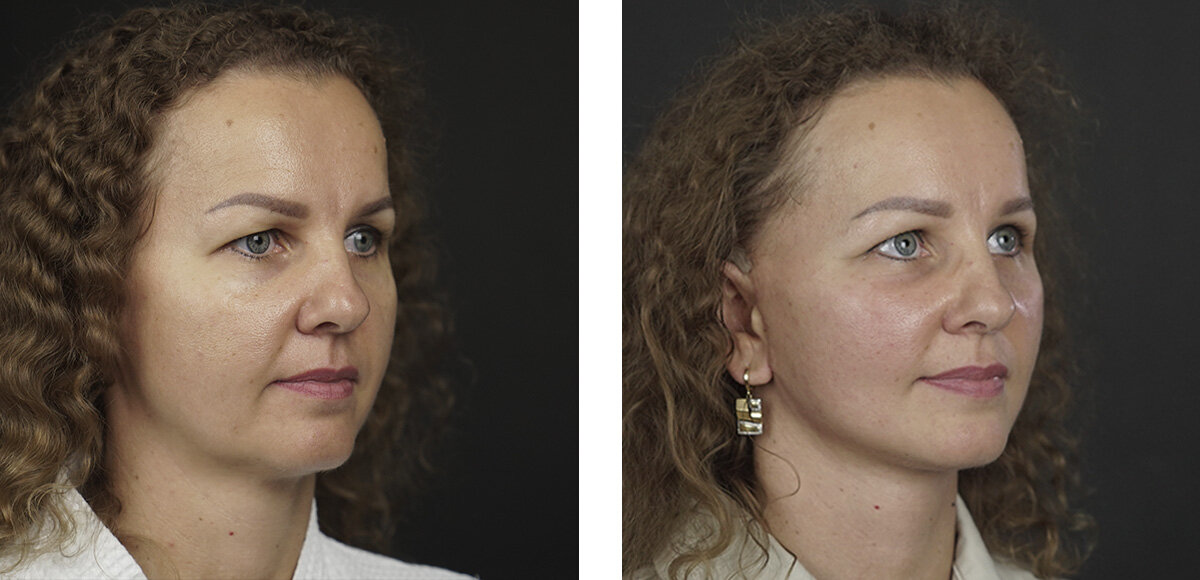 Фото Юлии до и спустя 3 недели после операции. Еще сохраняется отек, рубцы на стадии формирования. 