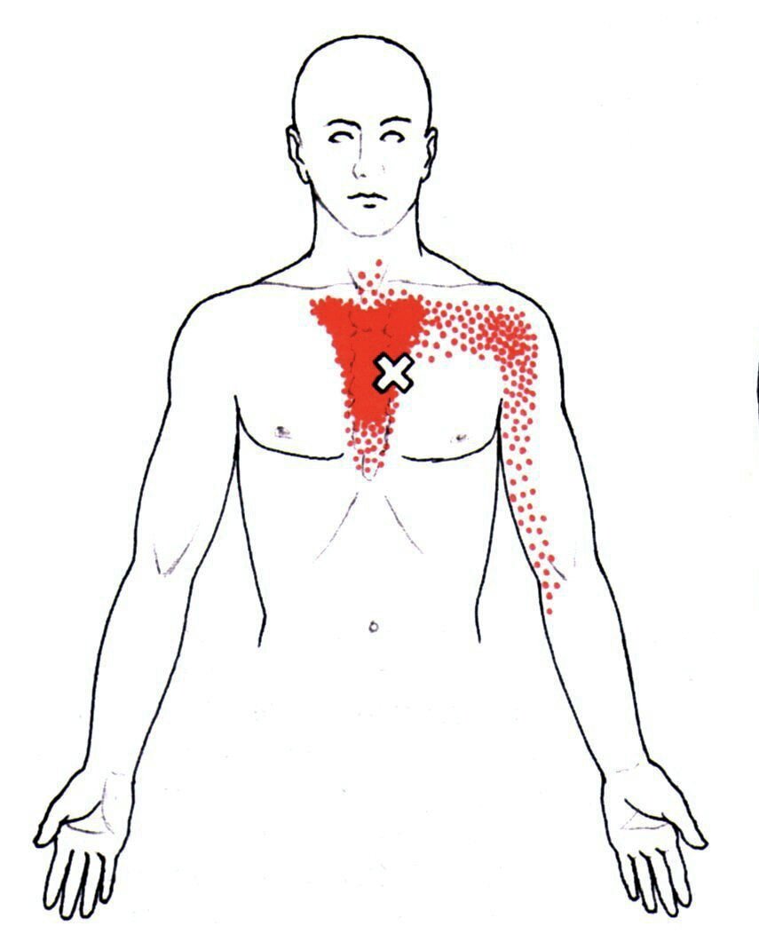 Триггерные точки на груди. Триггерные точки грудины. Триггерные точки в грудной мышце. Триггерные точки над грудью.