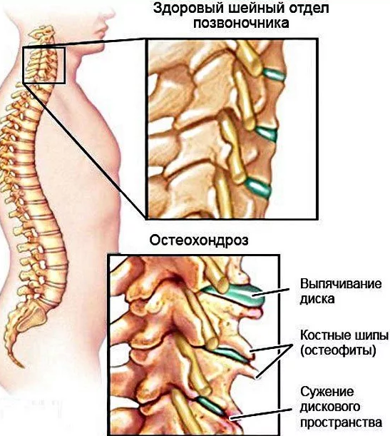 Головная боль при шейном остеохондрозе | Медицинская клиника в Санкт-Петербурге