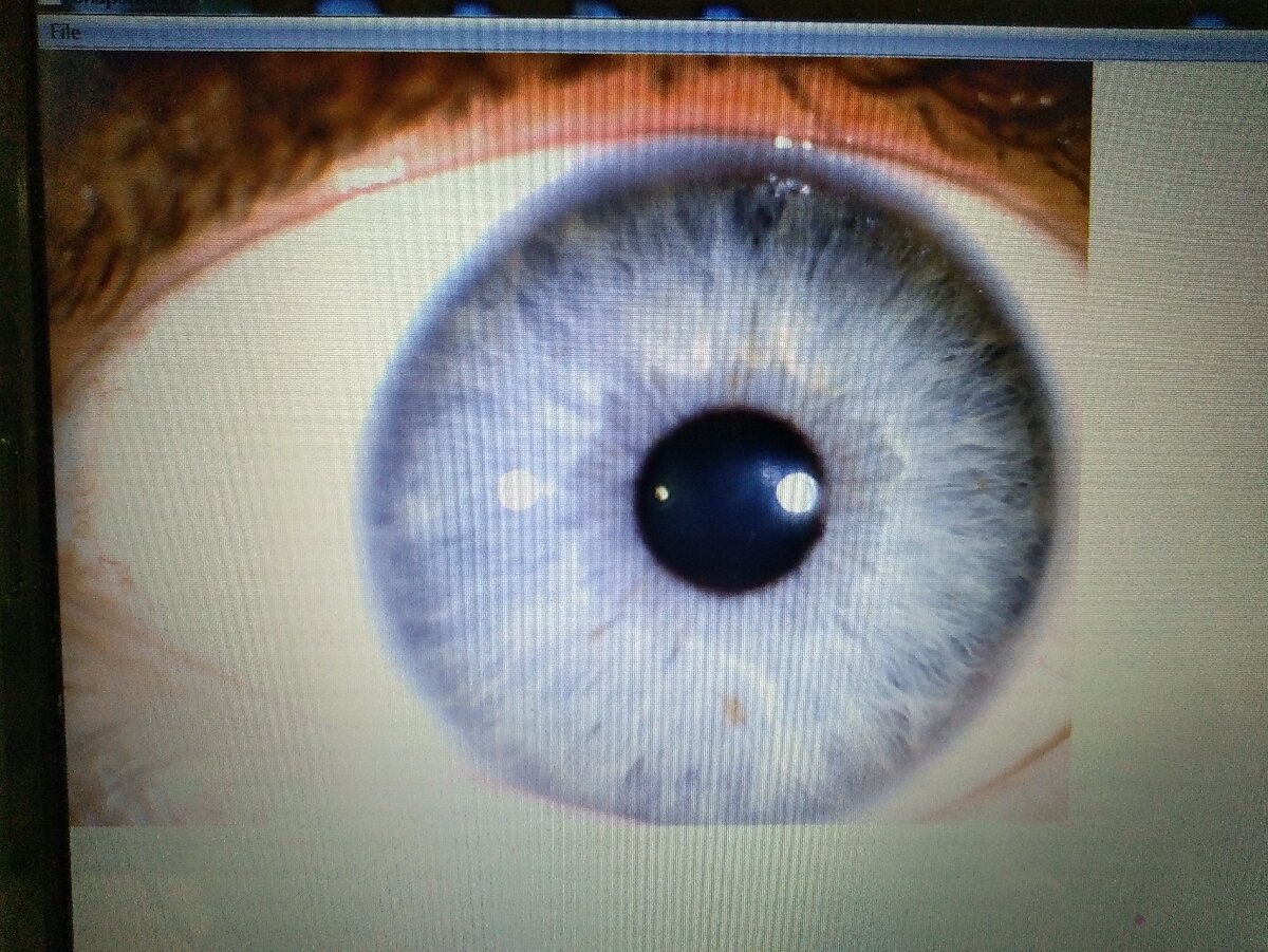 Иридодиагностика и наркоманы. В Иридодиагностике зона головного мозга находится с 11 часов дня до 13 00.(представляем глаз как циферблат).
Смотрим на 12 часов дня наверху.На этой зоне у пациента видно очень сильное разволокнение-внешне для обывателя это похоже на дырку...
Так вот...
Употребление наркотиков вызывает вполне конкретные изменения головного мозга,которые остаются на всю жизнь...и которые потом отражаются на проекционной зоне радужке глаза в виде разных знаков...
Вот и сегодня пришёл человек на иридодиагностику у которого я заметил доселе знакомый мне знак плюс моё природноё чутье...)))-пациент подтвердил о последствиях бурной экспериментальной молодости.Сосудистые изменения также видны на МРТ,которые клинически после адских угаров проявляются до сих пор.
не употребляйте.
