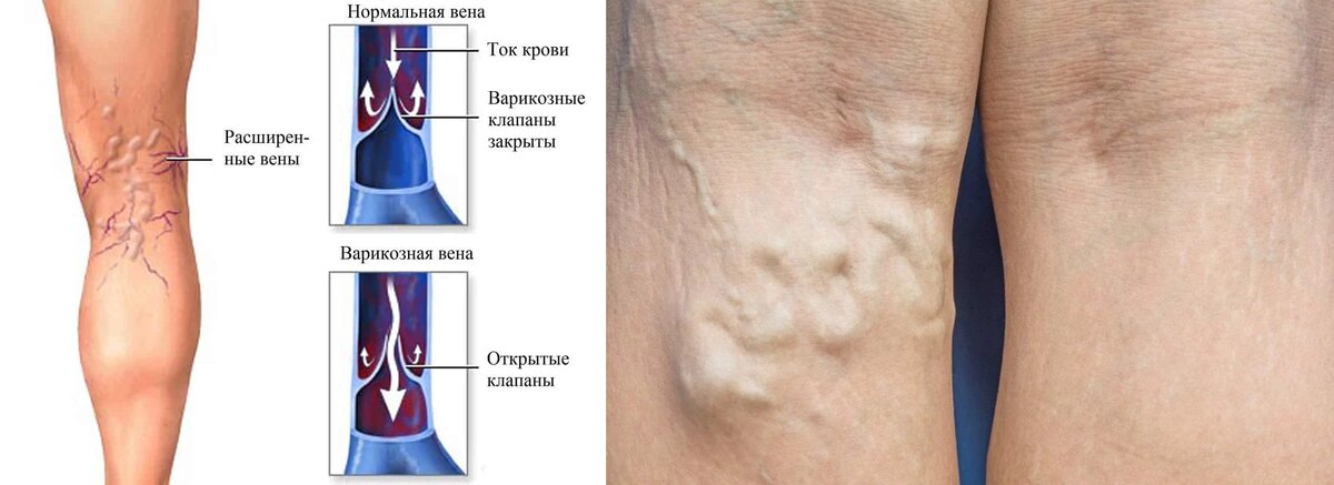 Причины и лечение варикоза у женщин