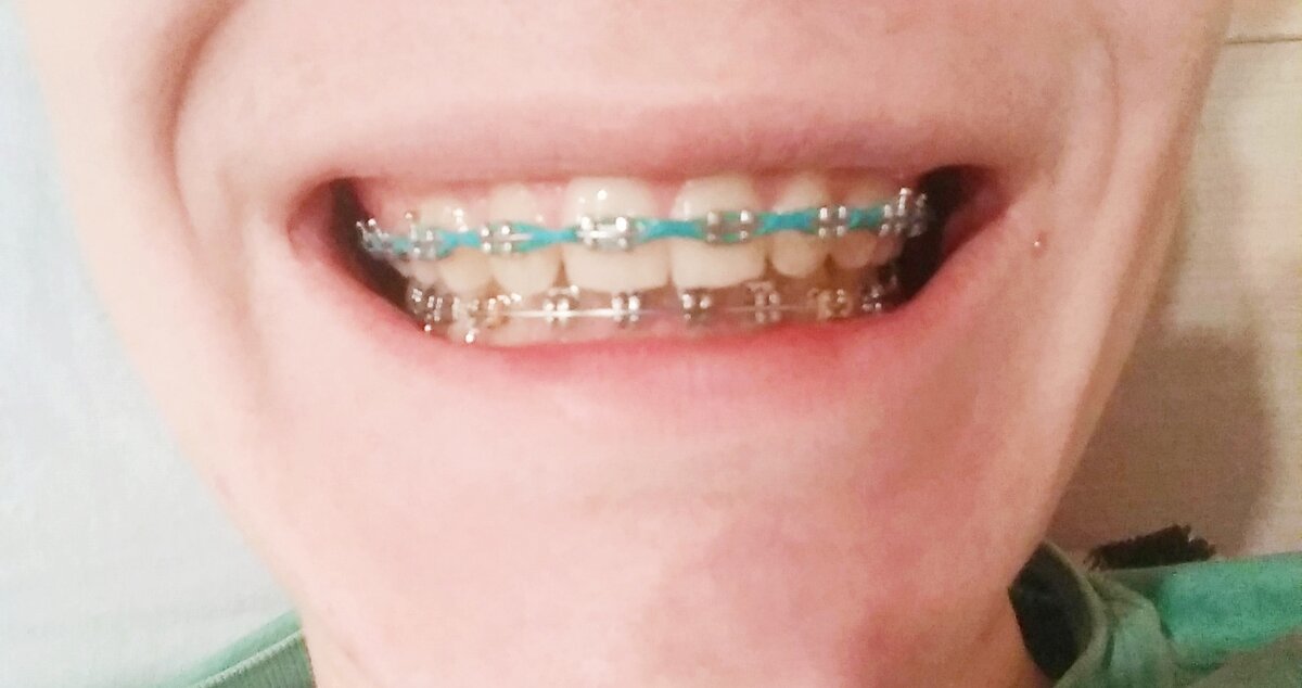 Это фото я сделал в последние дни ношения брекетов