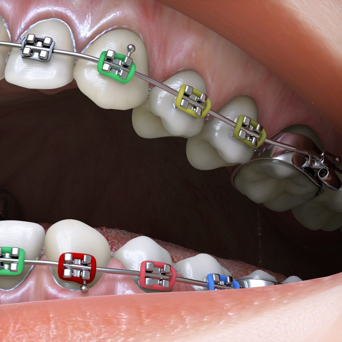 Лигатурные брекеты. За них тоже можно вернуть немного денег. 