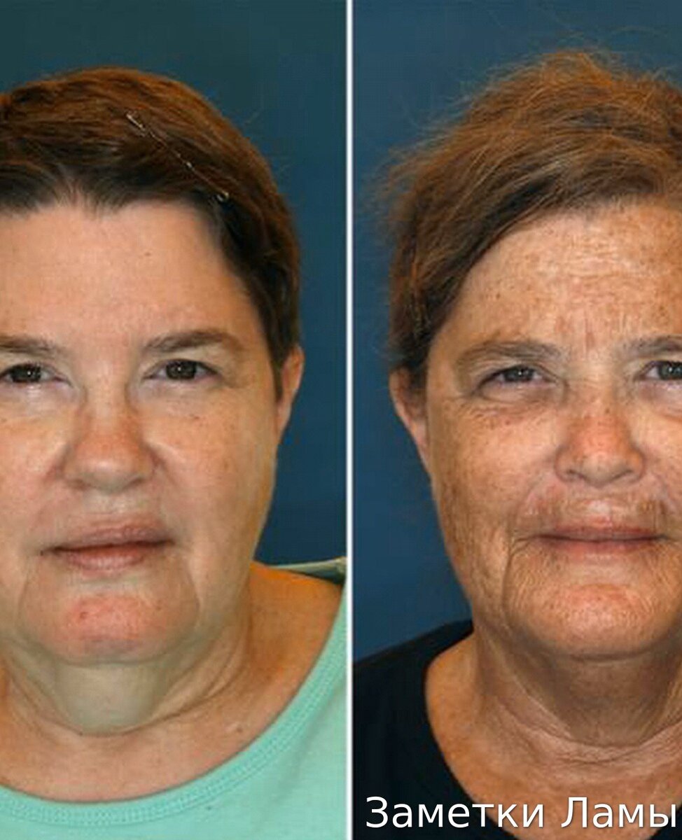 важно защищать кожу от солнца