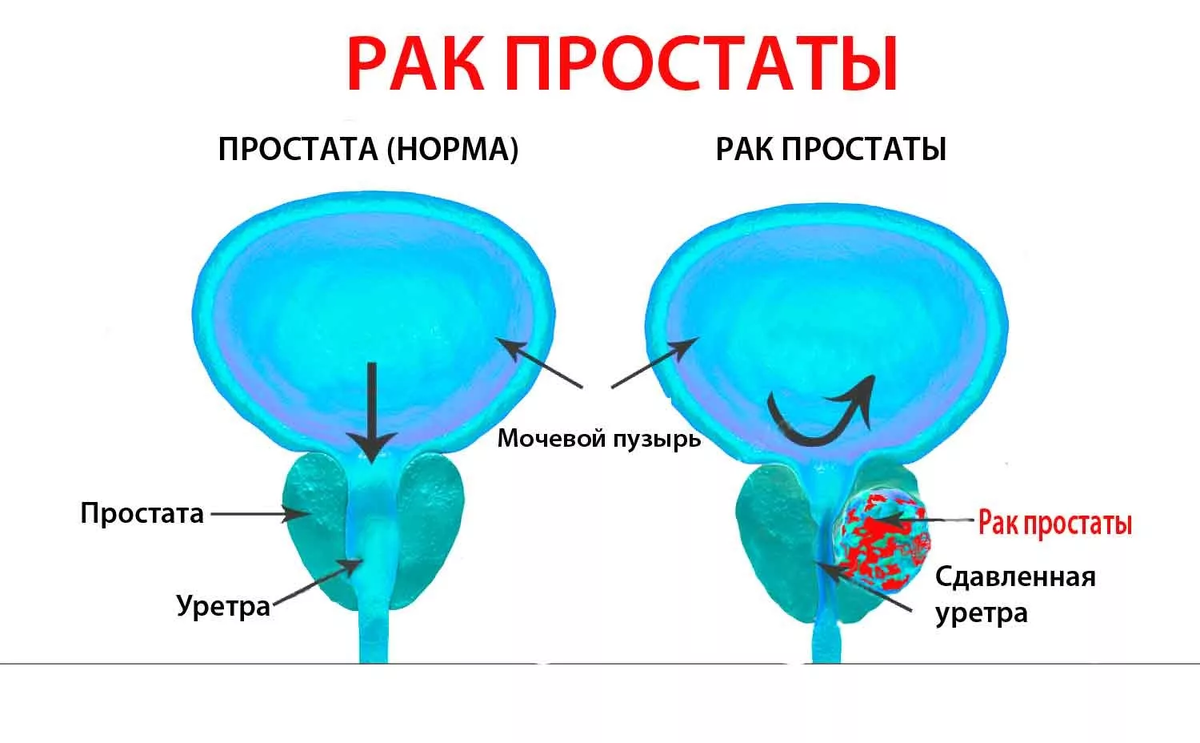 Самые распространенные симптомы онкологических заболеваний | ОК ДОК | Дзен