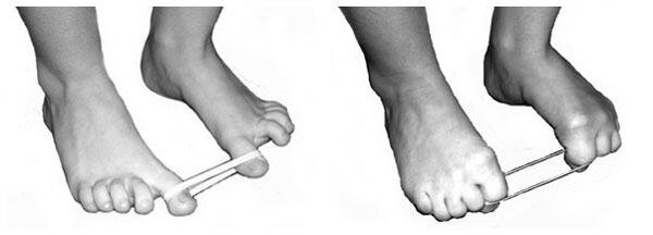 деформация резинки. упражнения против косточек на ногах. упражнения для большого пальца ноги при вальгусе. лфк при вальгусной деформации 1 пальцев стоп. формула деформации кольца.