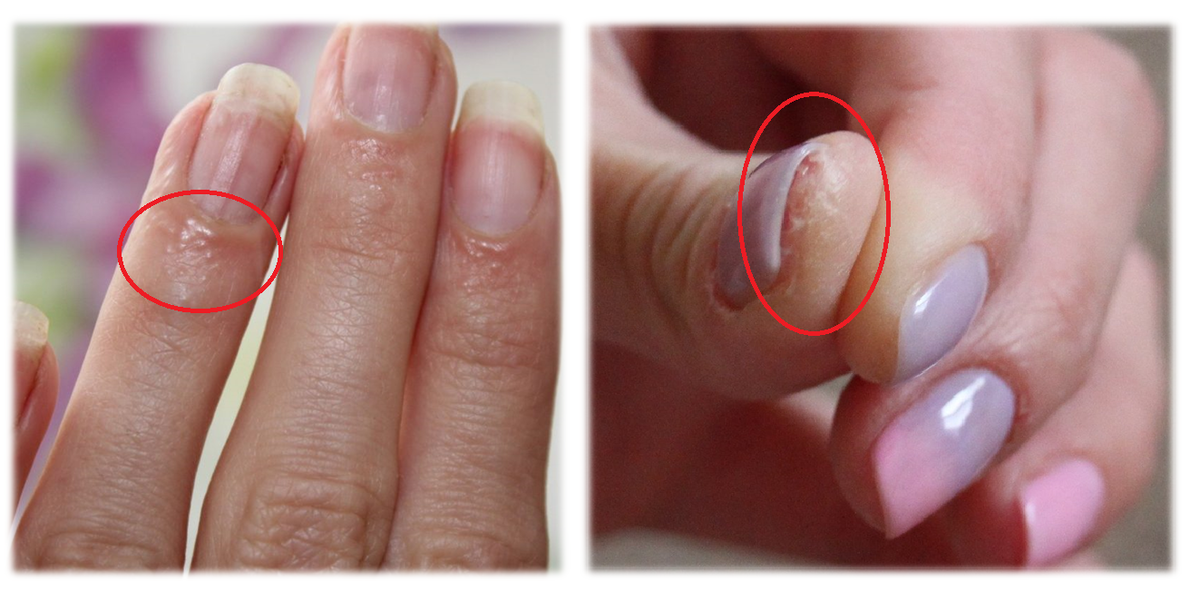 Аллергическая реакция в виде водянистых волдырей и очень сухой кожи. Сопровождается сильным зудом.