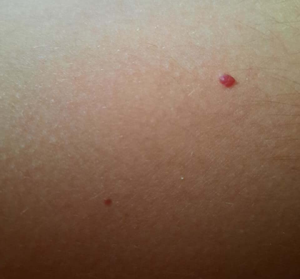 Ангиомы на поверхности кожи абсолютно безопасны 