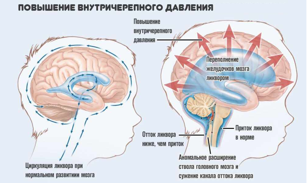 Повышенным может быть не только артериальное давление. Повыситься может и внутричерепное давление.-2