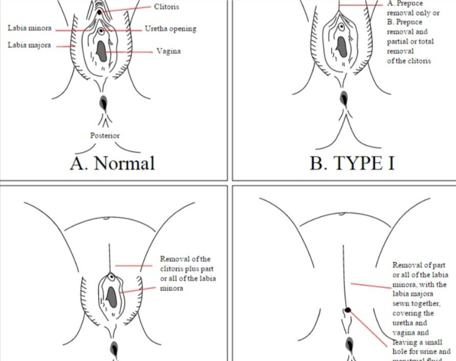 Виды женского обрезания