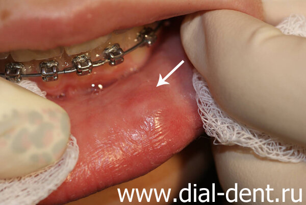 ретенционная киста слюнной железы