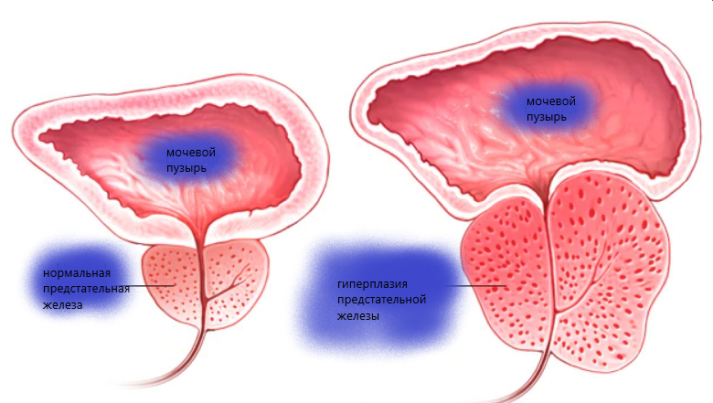 Гиперплазия предстательной железы картинки