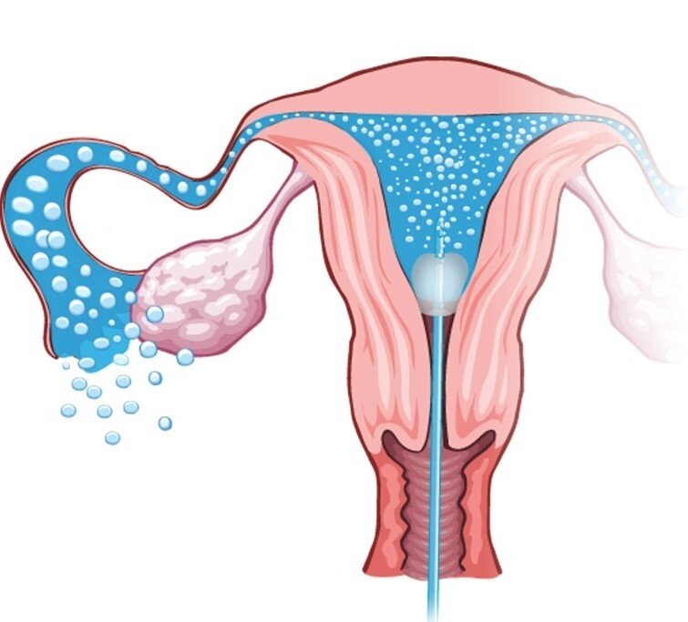 Оценка проходимости маточных труб.