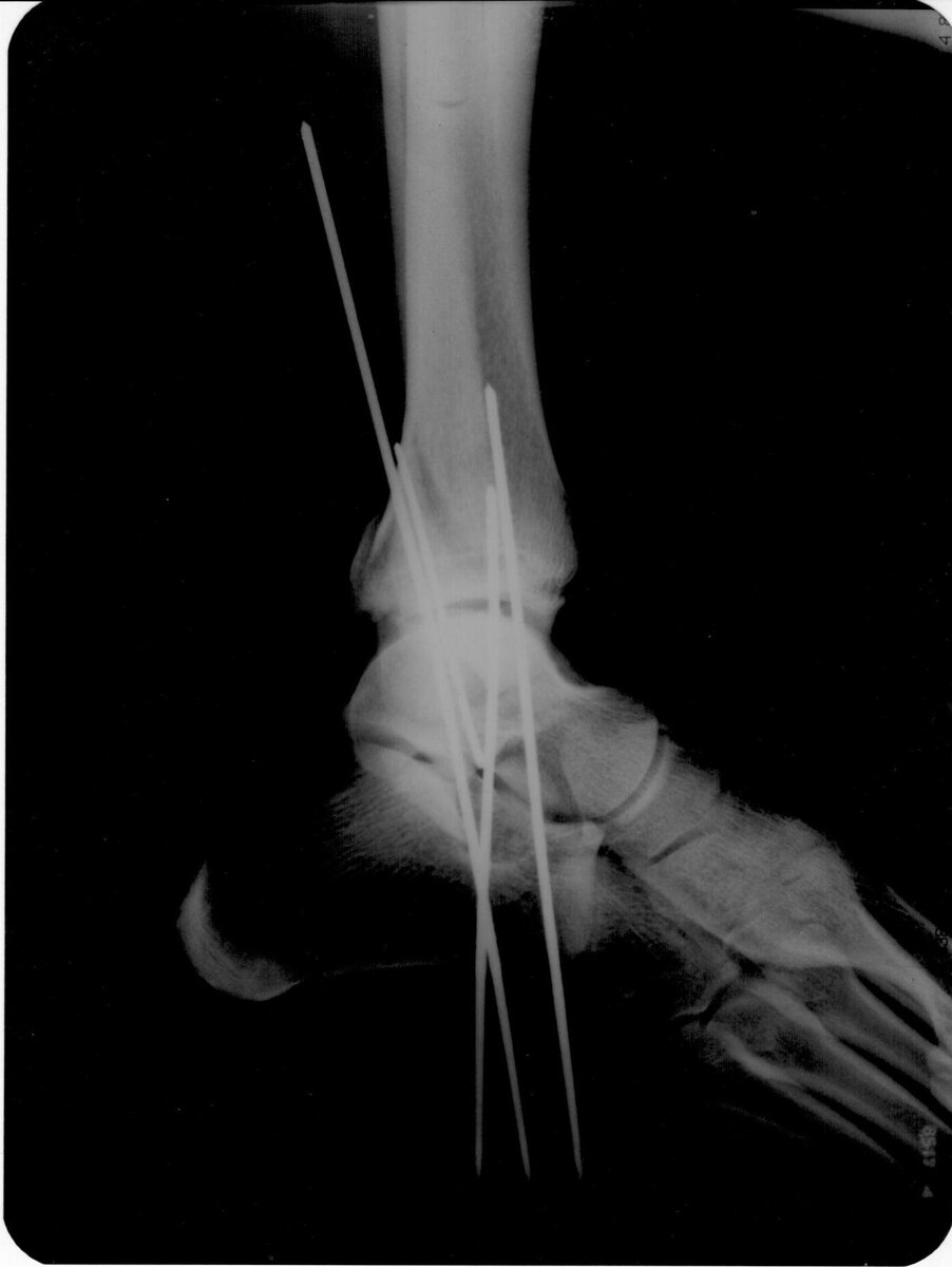 Рентгеновский снимок. Трехлодыжечный перелом со смещением