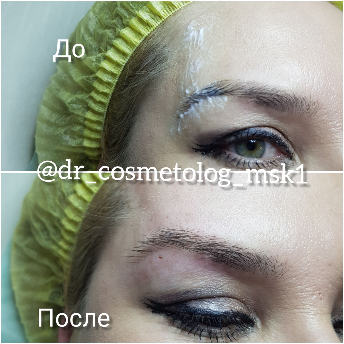 Лифтинг брови при помощи нитей