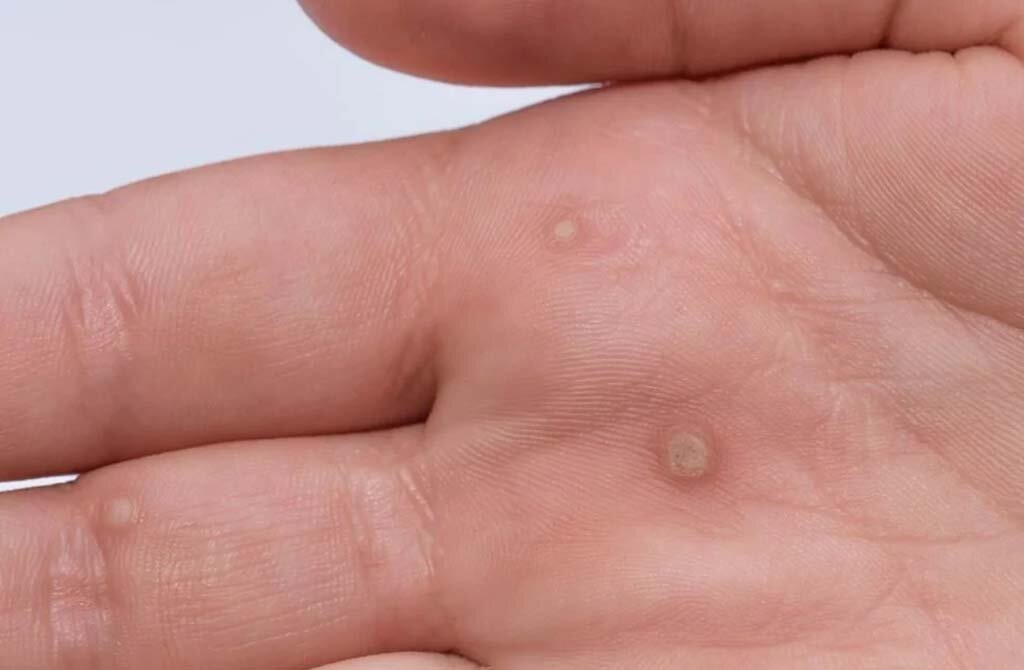 Бородавки на ладони. Фото из Google.