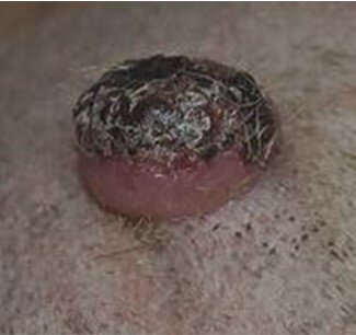 так выглядит гистиоцитома