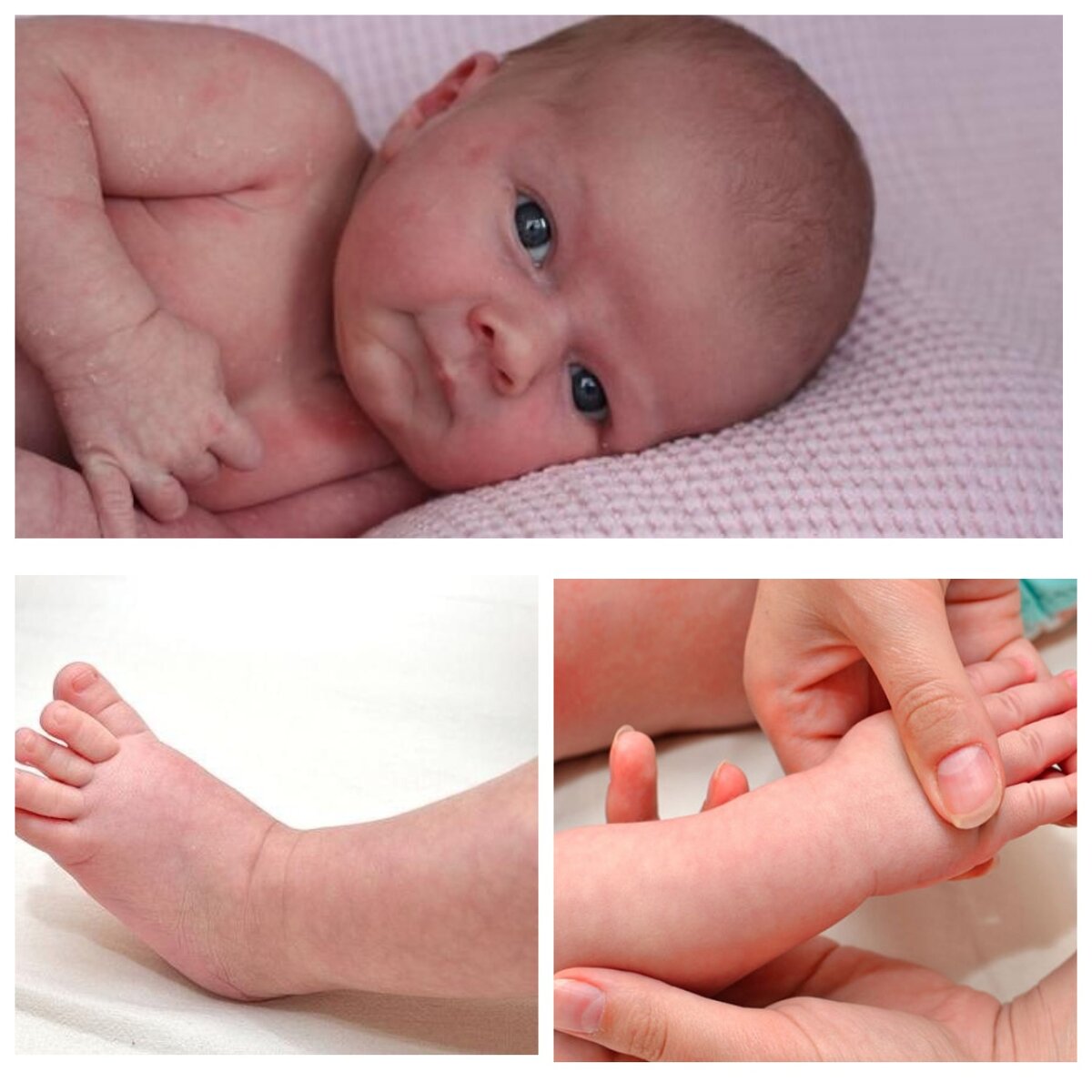 ПРИ ЭТОМ КОЖА ПРИОБРЕТАЕТ НЕРАВНОМЕРНУЮ, «ПЯТНИСТУЮ» ОКРАСКУ, ГДЕ СЕТЧАТЫЙ ИЛИ ВЕТВИСТЫЙ РИСУНОК, ИМЕЮЩИЙ СЛЕГКА СИНЮШНЫЙ ИЛИ БАГРОВЫЙ ОТТЕНОК, ОКРУЖАЕТ МЕЛКИЕ БЛЕДНЫЕ ОБЛАСТИ. ТАКИМ ОБРАЗОМ, КОЖА СТАНОВИТСЯ ПОХОЖЕЙ НА МРАМОР, ЧТО И ДАЛО НАЗВАНИЕ ЭТОМУ СОСТОЯНИЮ. 