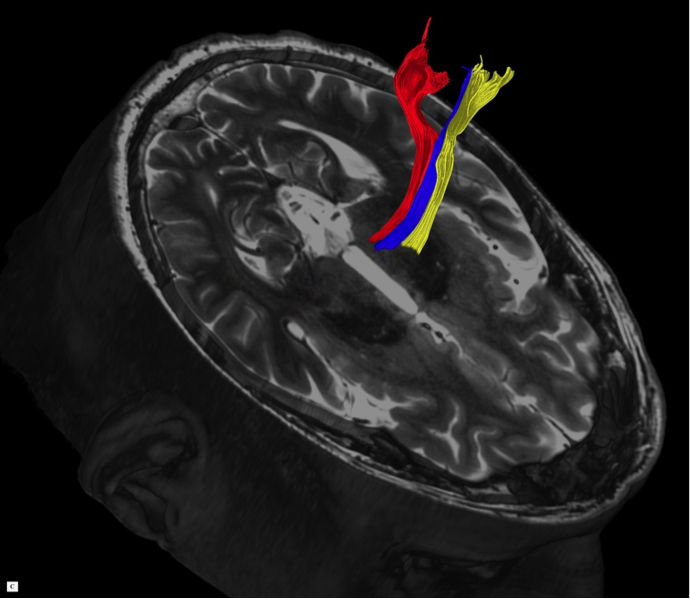 Мрт взрослому. Трактография мрт. MRI Master планинг головного мозга ММУ. Болезнь Паркинсона мрт мрт. Мрт при болезни Паркинсона Паркинсона.