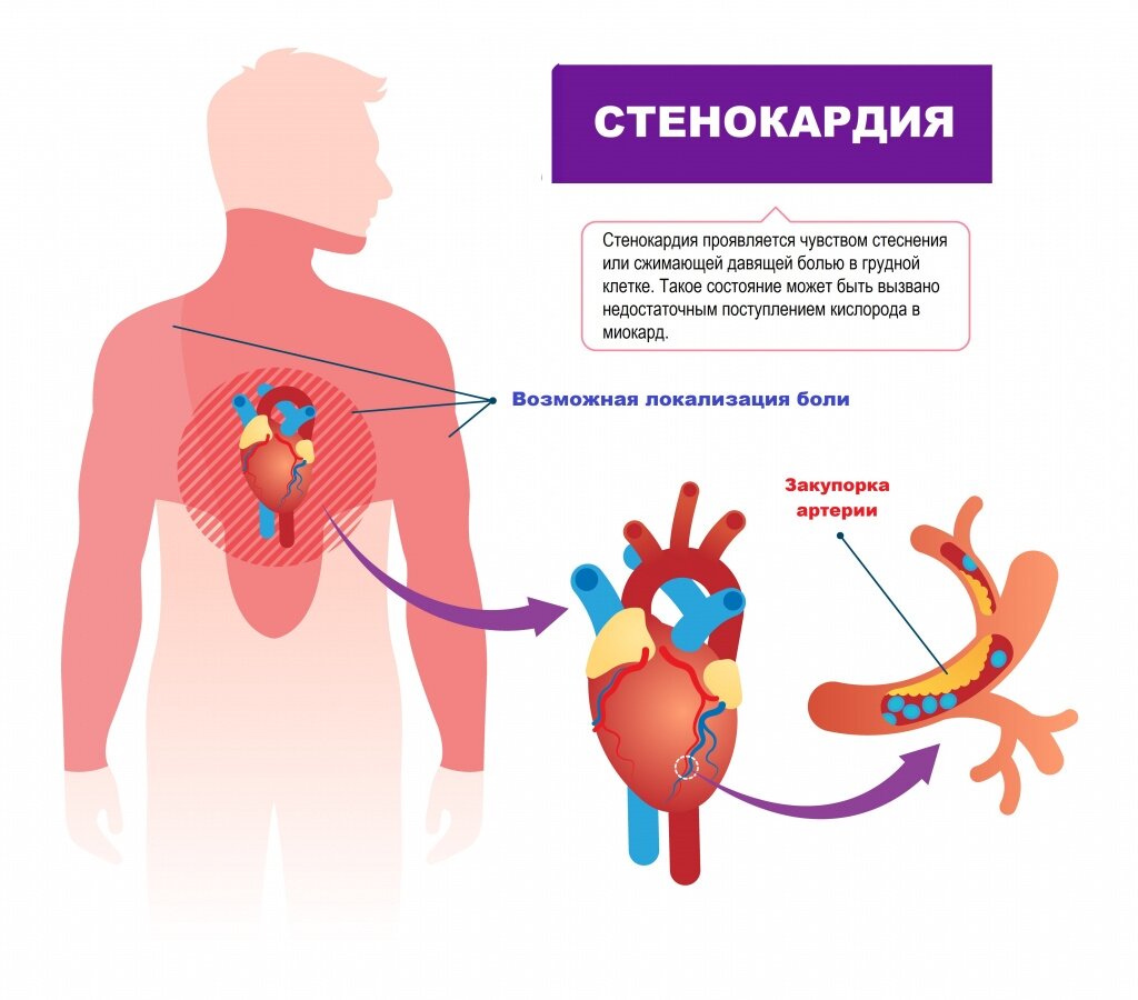 Стенокардия. Симптомы и жалобы | Здоровый человек | Дзен