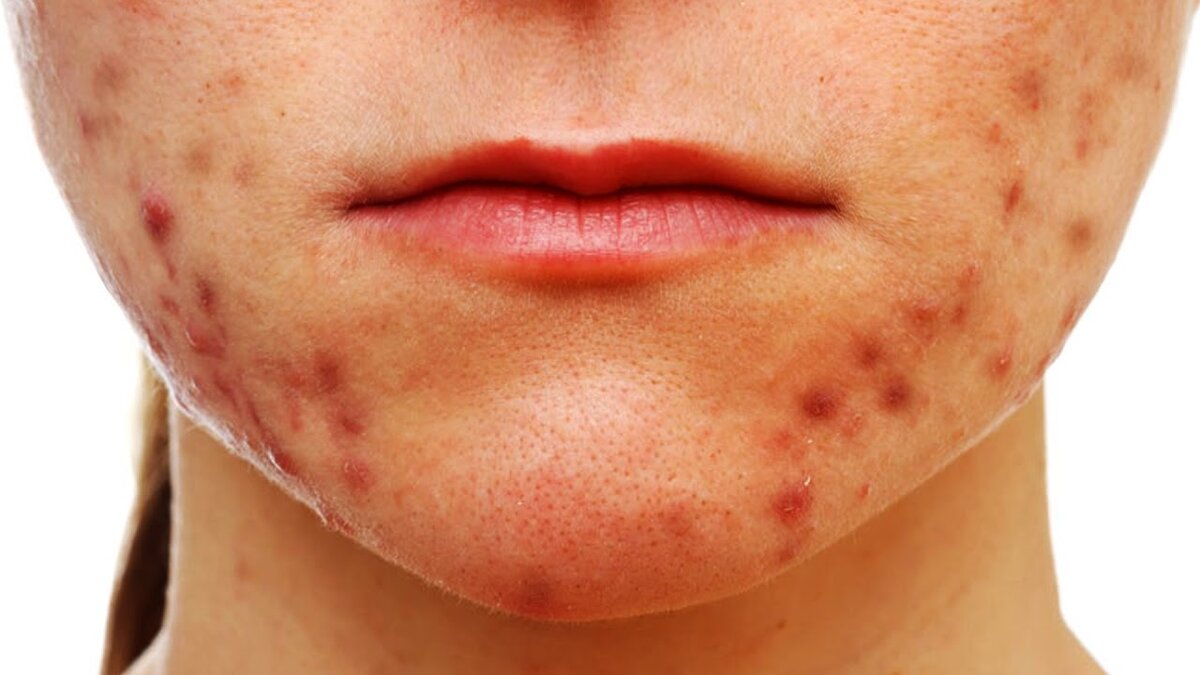 Розовая угревая сыпь