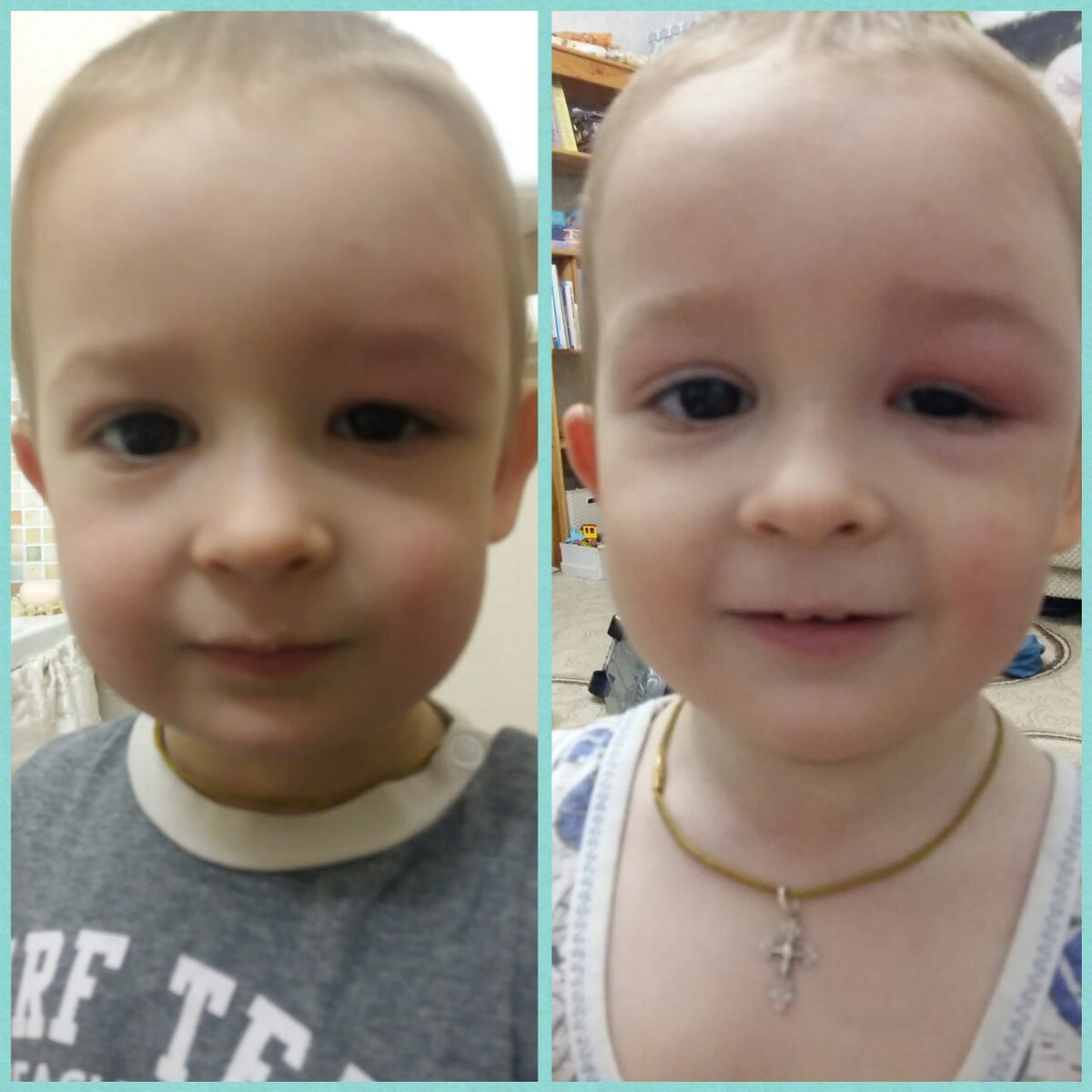 Слева – фото утром до лечения народными средствами, справа – вечер, после лечения.