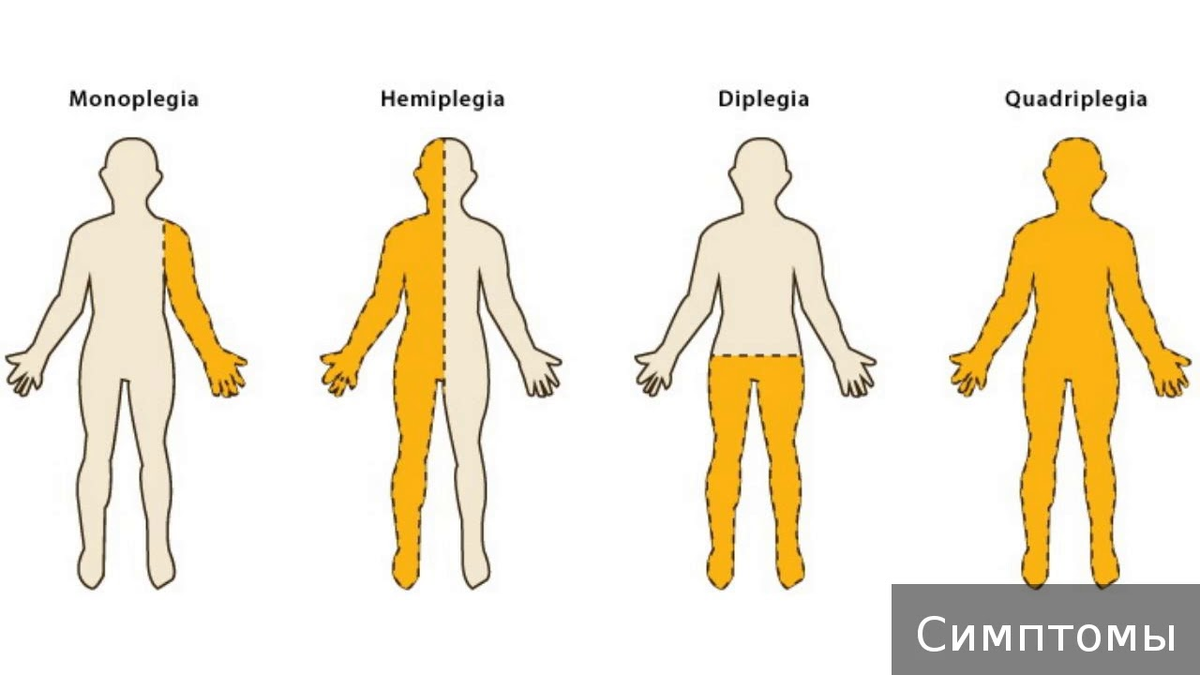 Тело парализовало. Гемиплегия диплегия тетраплегия. Моноплегия параплегия гемиплегия тетраплегия.