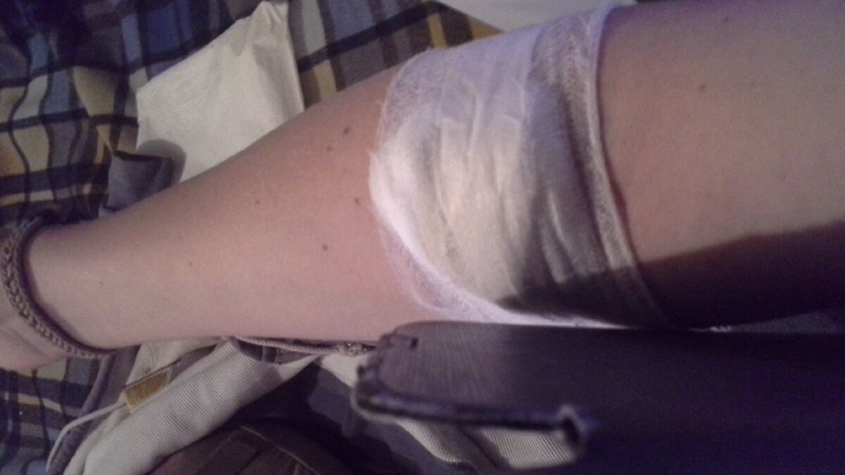 Моя рука после донации 