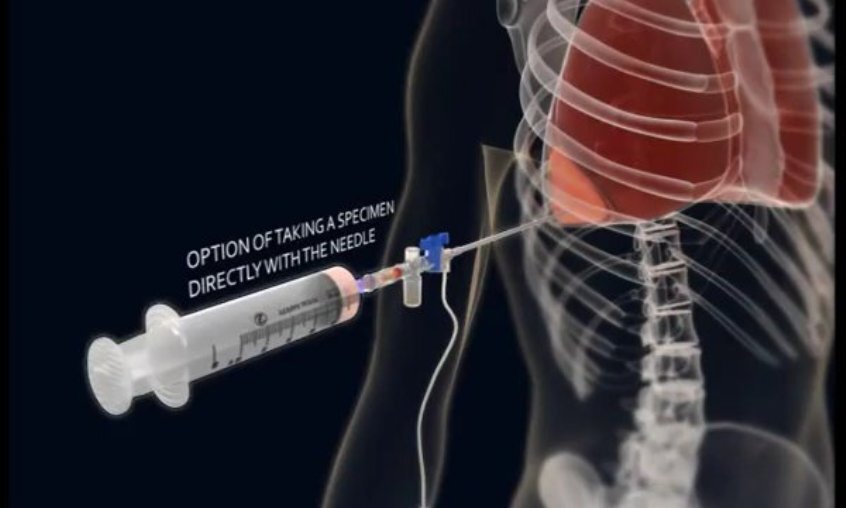 Mythovent аппарат ивл. искусственная вентиляция лёгких. воздух после операции. кислородная маска в реанимации. лапароскопия кисты яичника швы.