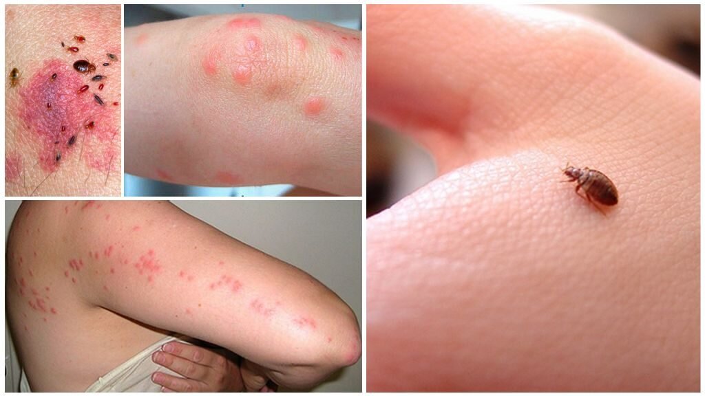 Как выглядят укусы клопов