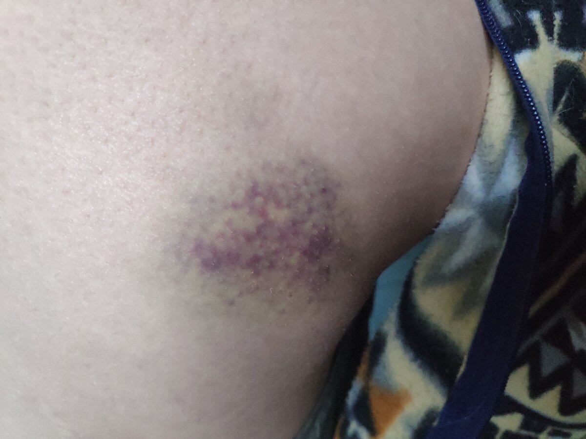 Мой недавний синяк