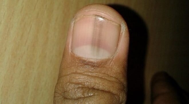 9 причин появления черных полос на ногтях Черные полоски или борозды на ногтях – частое явление. Их появлением организм пытается обратить внимание своего хозяина на то, что с ним что-то не так.-2