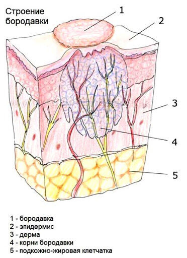 Обратите внимание, что бородавка состоит из корней.