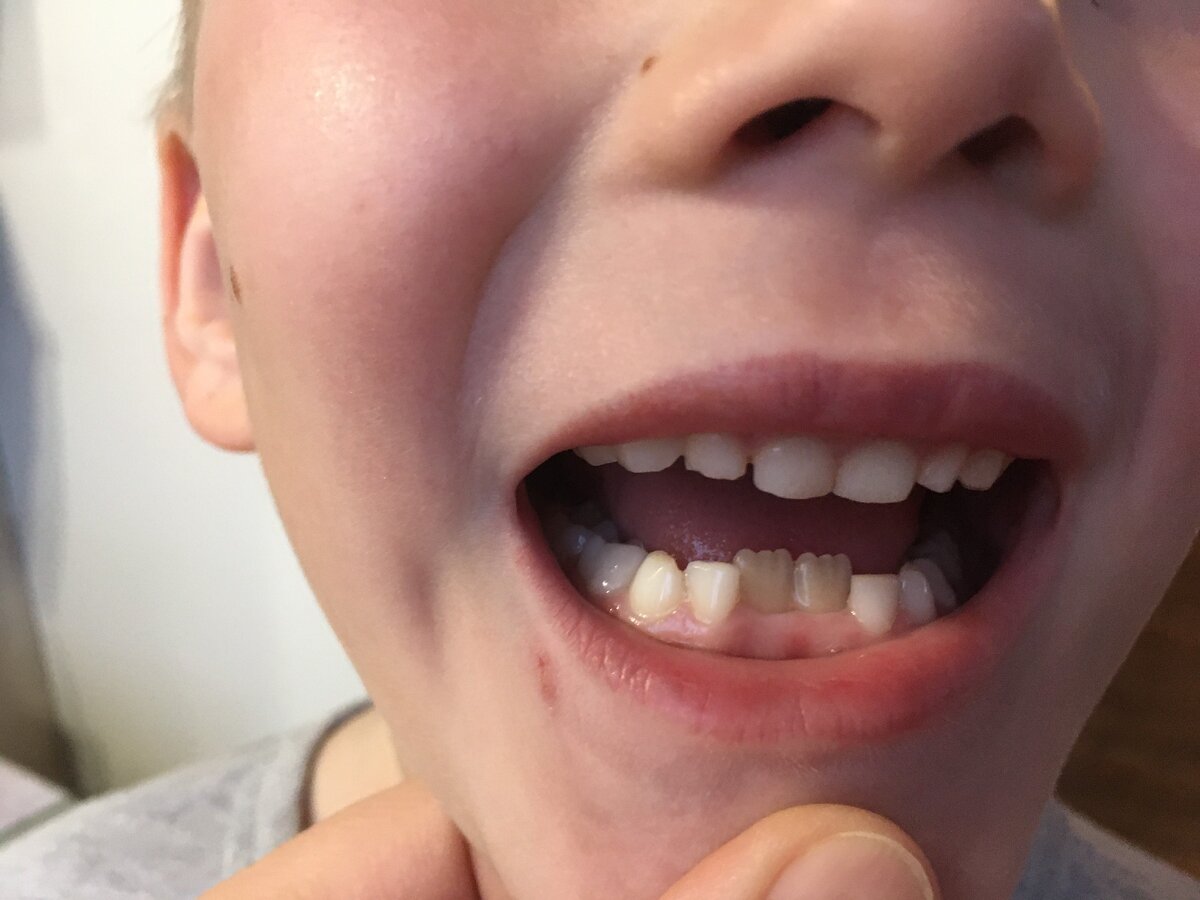 Зубы, спустя полгода. Январь 2021 г.