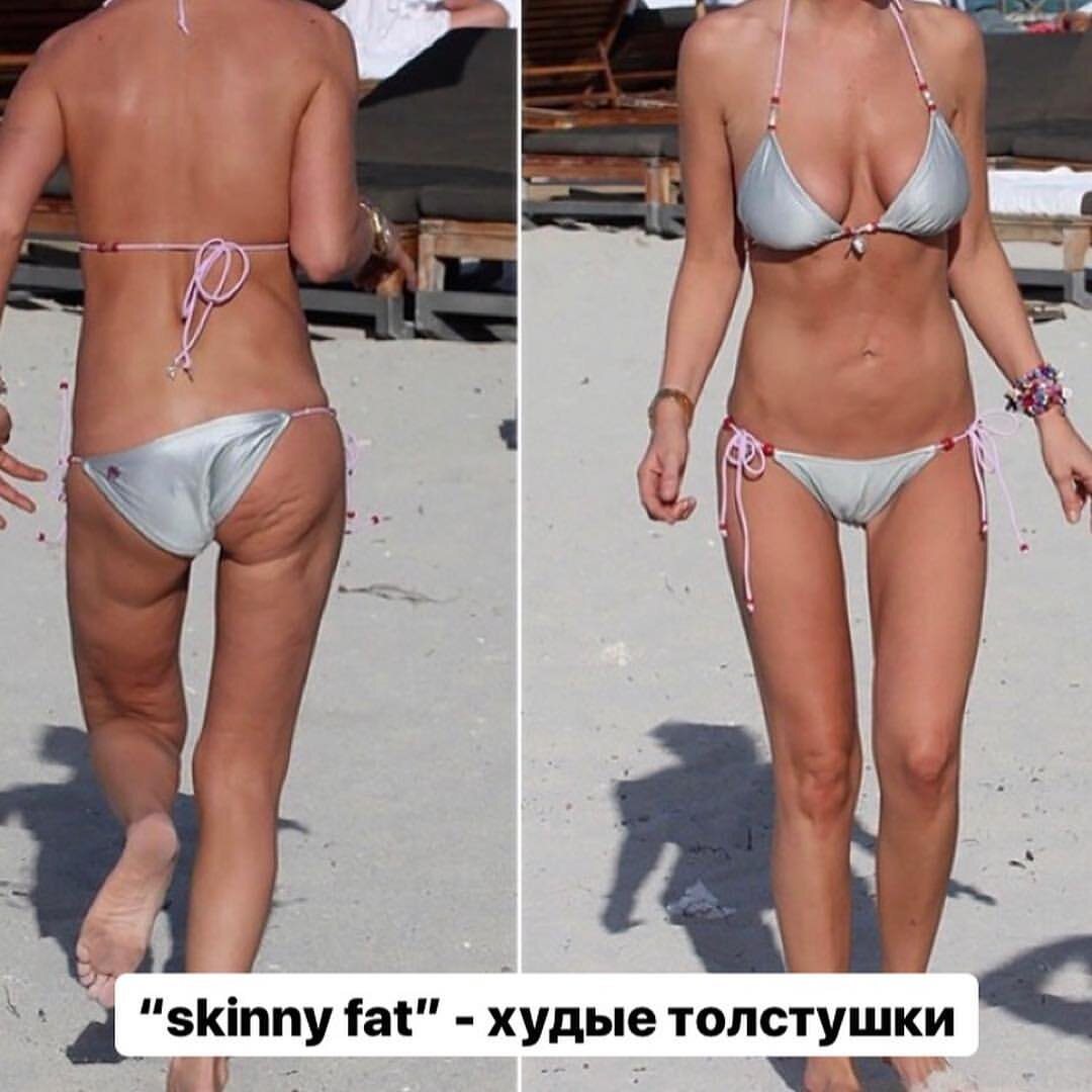 Наличие целлюлита у девушек-нормальное явление. Но тут, кажется, расклад немного другой.