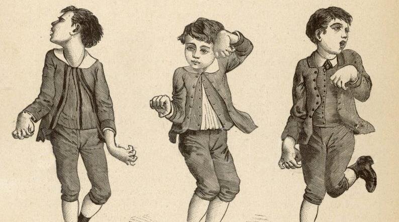 Хорея Гентингтона у детей