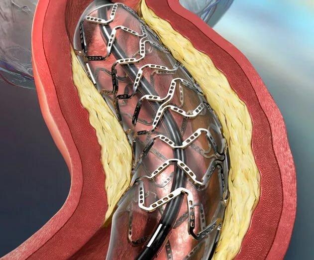 Схема стентирования сосудов сердца