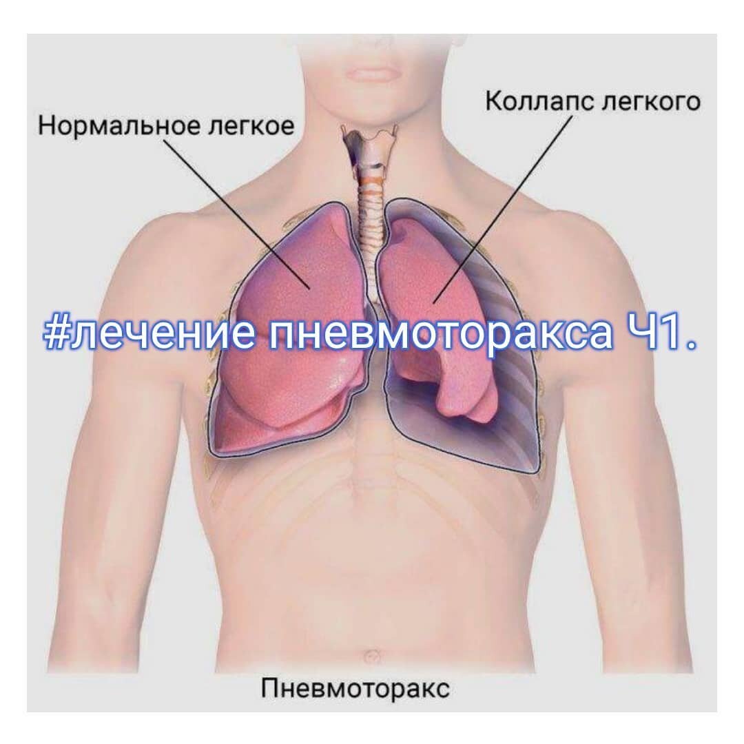 Отсасывающий дренаж из плевральной полости