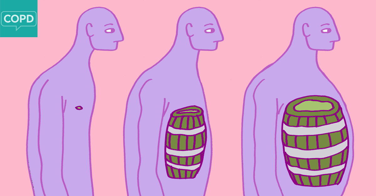 Бочкообразная грудная клетка как проявление эмфиземы