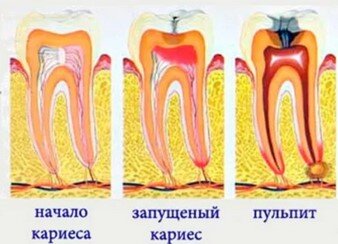 Пломбирование каналов