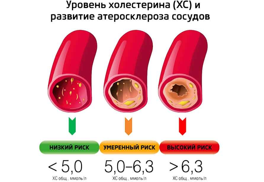 Гиперхолестеринемия (повышенный уровень холестерина)