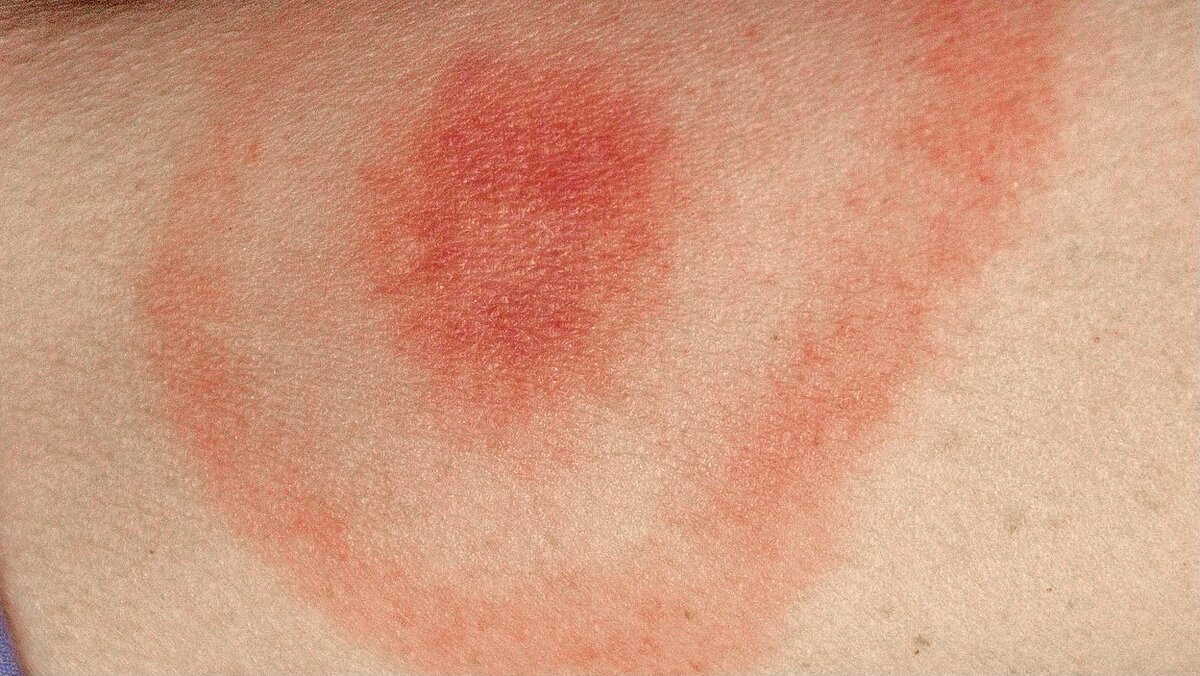 Кольцевидная эритема