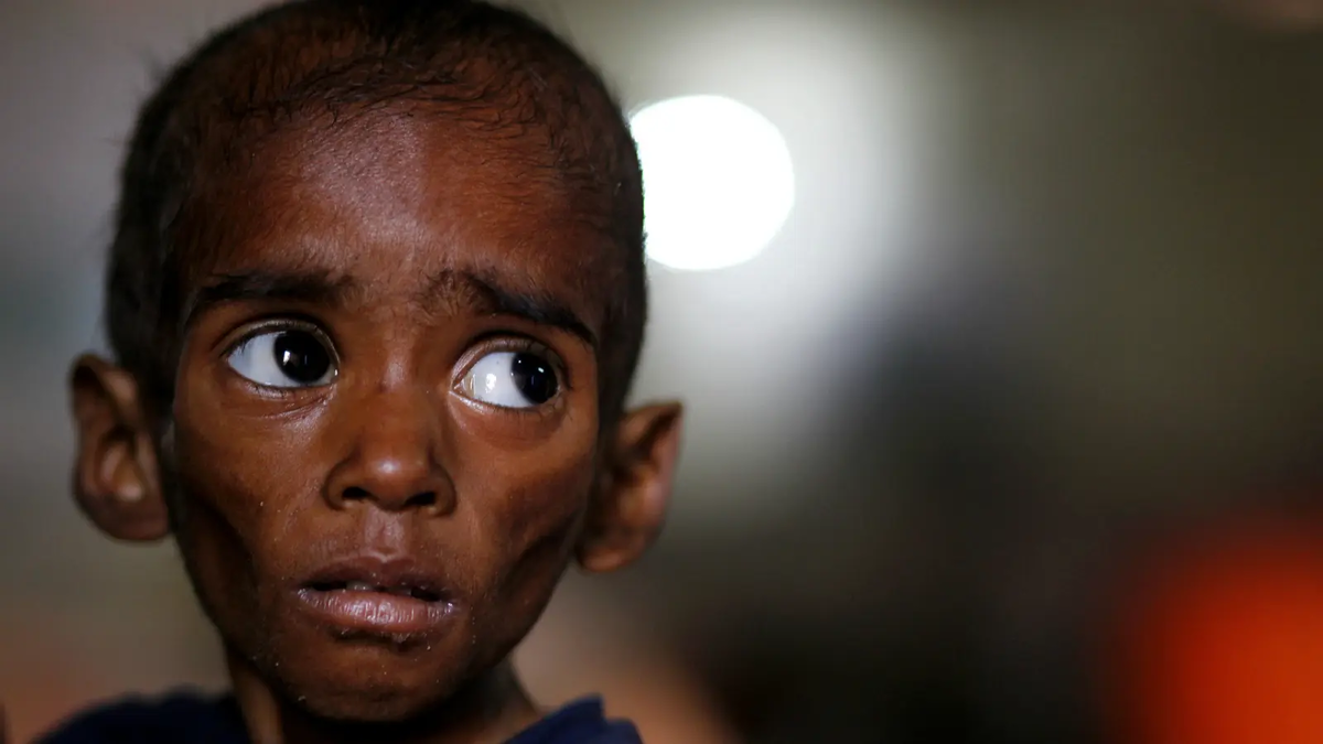 Child malnutrition in Mali hits highest level in 10 years - African Initiative -
