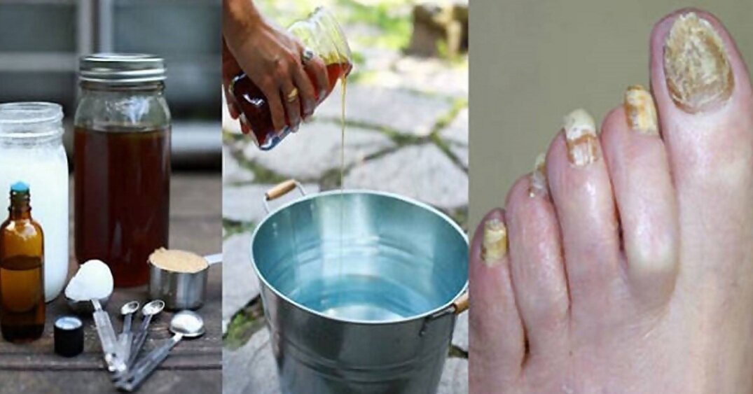 Лечения грибка ногтя маслом. Народные средства от грибка ногтей. Вылечил ногти от грибка.