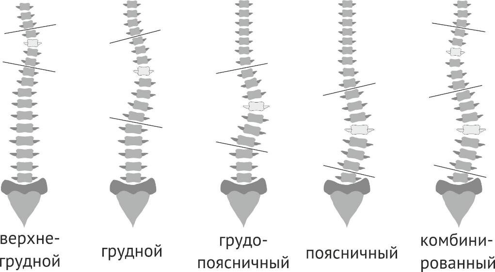 Виды сколиоза позвоночника проект